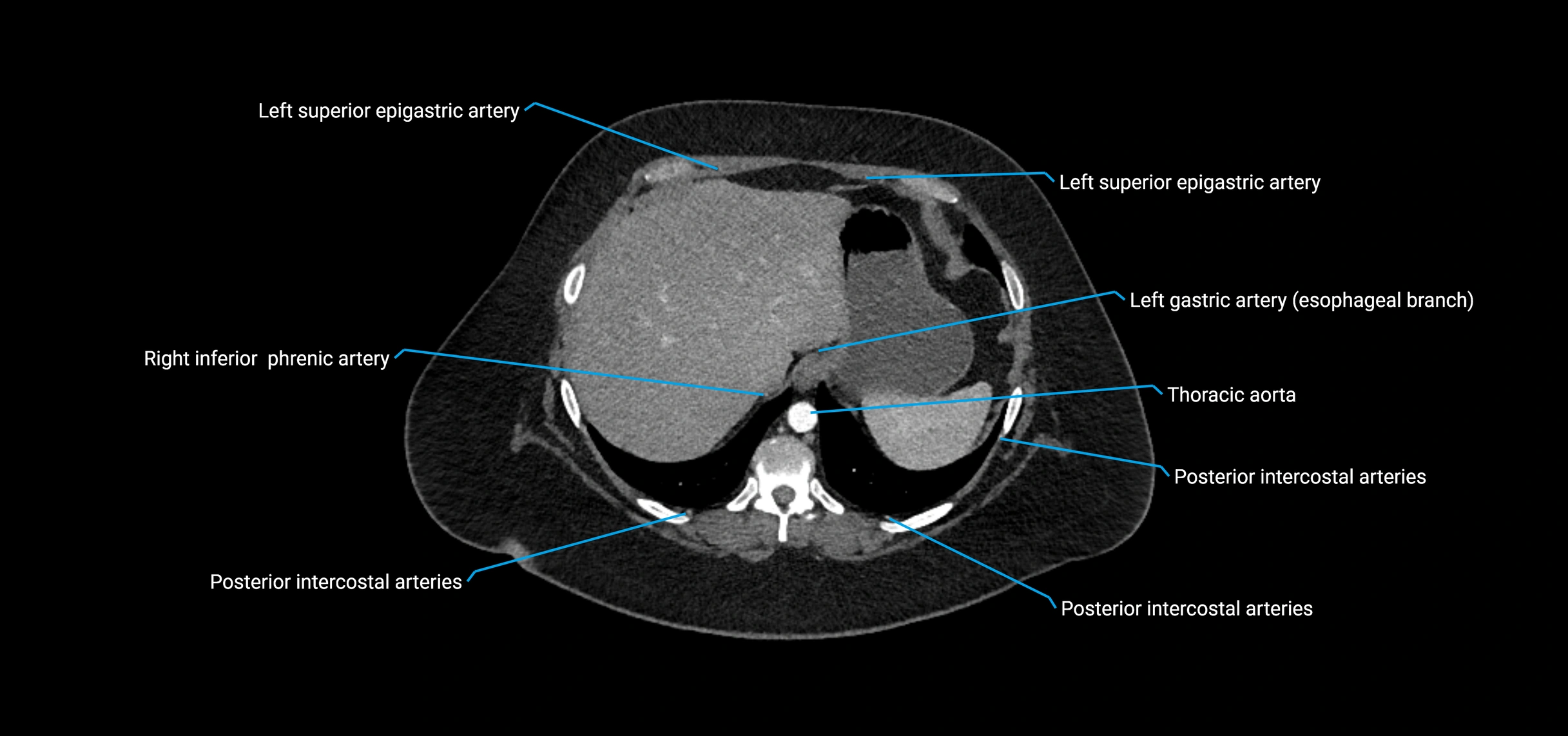CTA abdomen axial cross sectional anatomy labelled image_27 (3).webp
